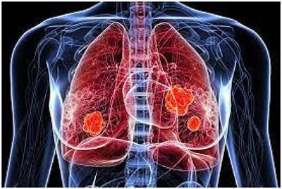 Lung tumor segmentation: a review of the state of the art